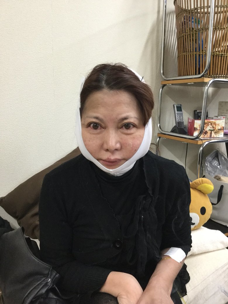 フェイスリフトの手術後
