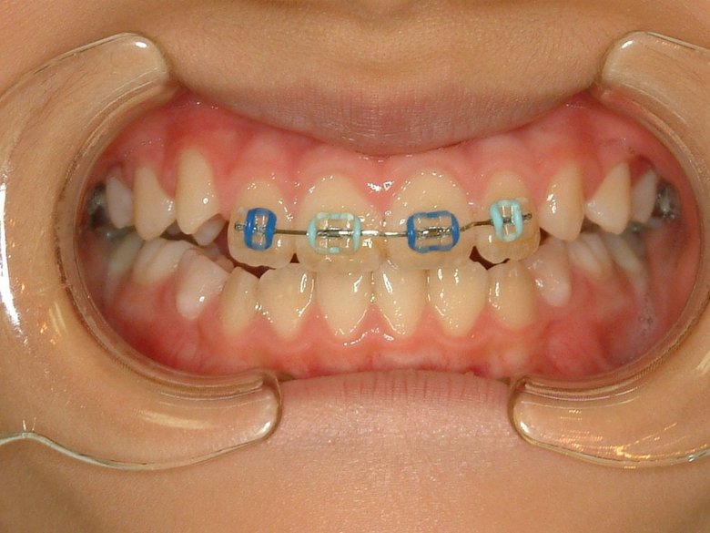▲「飾りゴム」装着時