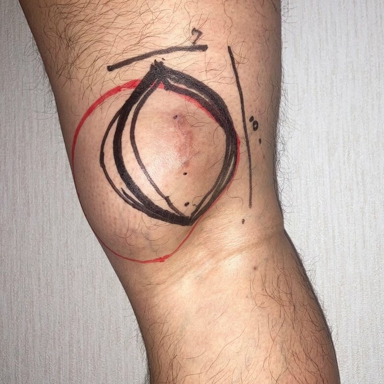 腫瘍摘出前、ペンで切除部分を描かれた