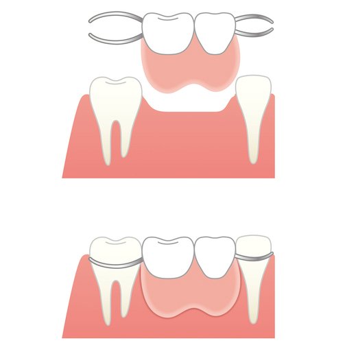 部分入れ歯のイメージ。部分入れ歯は両隣の歯に金属をひっかける。ほかの歯を削ることはないが、位置によっては金属が見えやすい