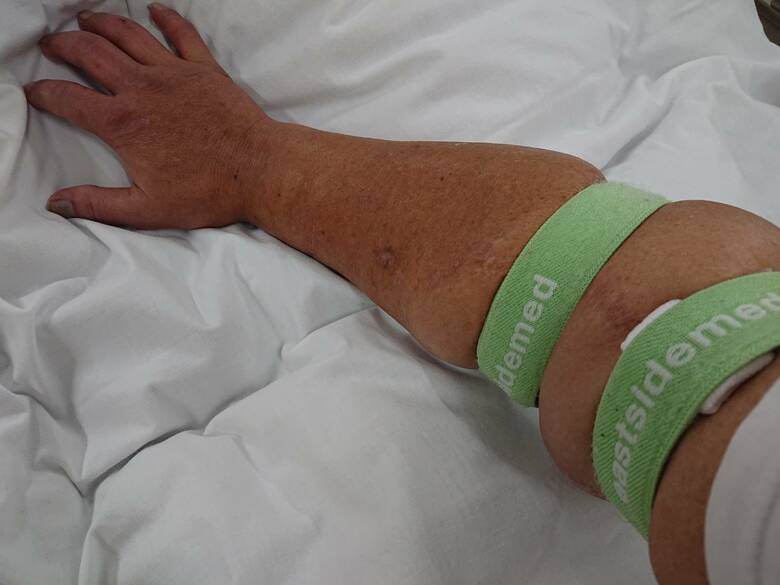 透析はカテーテルという血管アクセスを使用