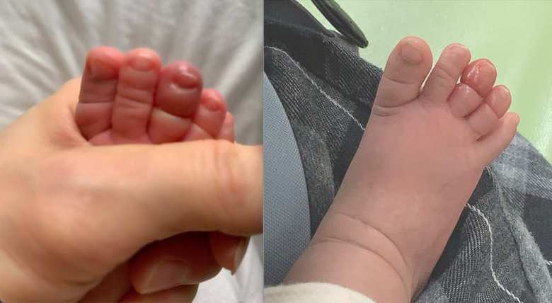 自宅と病院の待合室で記録のために撮影した写真  特に中指の腫れがひどいことがわかる（21年9月 紺野あさ美さん撮影）