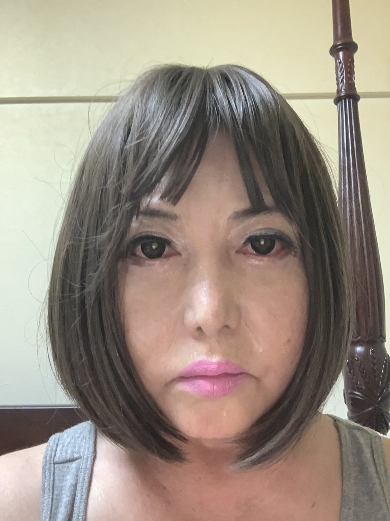 美容整形後の写真。スティッフパーソン症候群の疑いで入院後もしばらく美容整形を受けていた