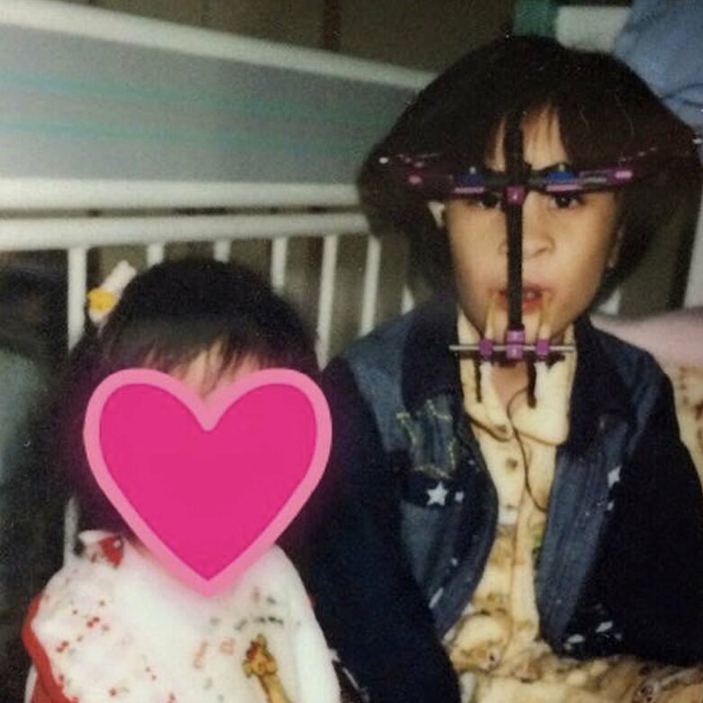 9歳のとき、上顎骨延長手術で入院