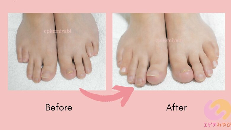 足の指が短い人も、エピテーゼで自然な指先となる