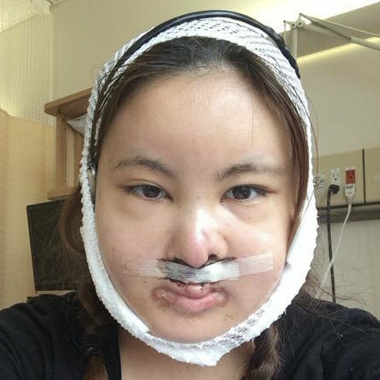 あごの手術を受けた22歳のとき。最後の手術は2021年、27歳のときだった