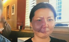 「スカート破られ、砂を食べさせられた」生まれつき右顔にあざをもつ女性が受けた壮絶ないじめ「目の前の鉛筆すら敵に見えた」