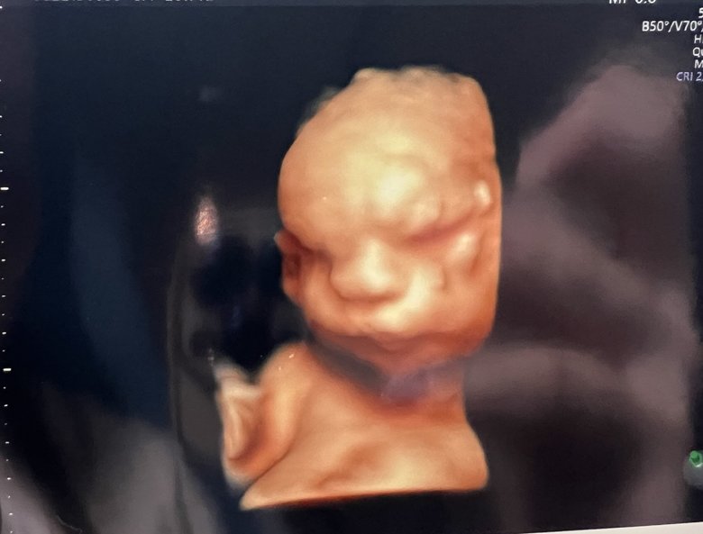 妊娠28週（妊娠8か月）のころのエコー画像