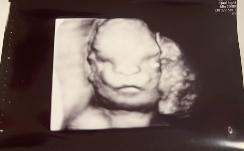 異常発覚後、妊娠24週（妊娠7か月）のころのエコー画像