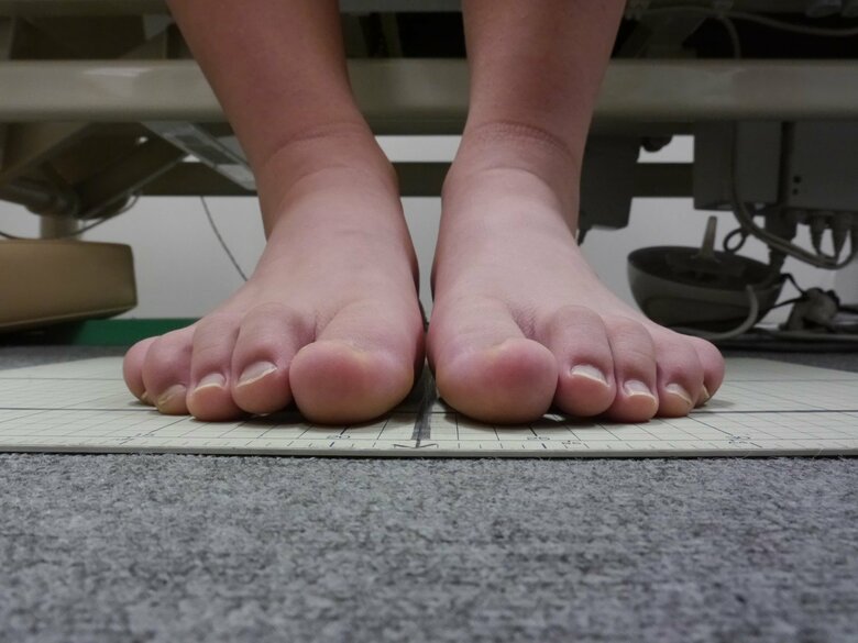 足指が曲がって丸まっている「かがみ指」