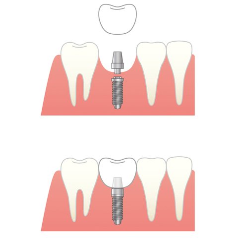 インプラント治療のイメージ。インプラントは人工歯根を埋め込み、それを土台に人工歯を取りつけるもの