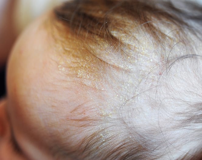 赤ちゃんの頭に かさぶた状 の湿疹 脂漏性皮膚炎 で注意すべきこと Chanto Web