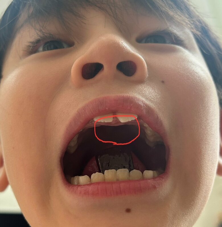 次男の前歯の裏側に過剰歯が。来年1月に手術で抜歯予定