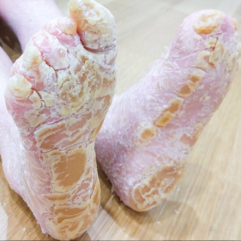 賀久くんの足の裏は分厚い皮膚に覆われ、指が分離していないところも