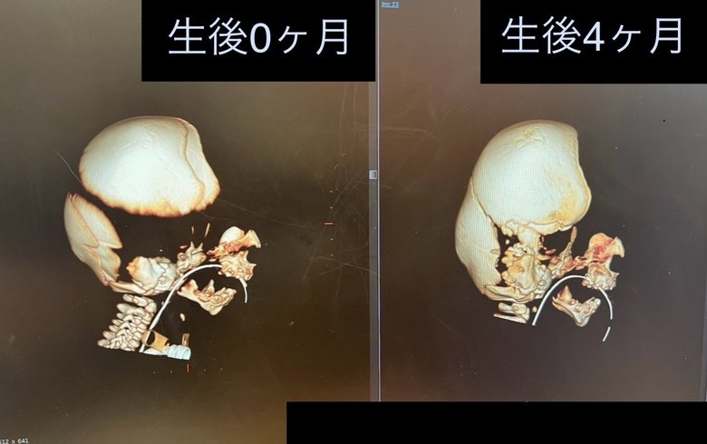 生後0か月と4か月に撮った頭蓋骨のCT結果画像