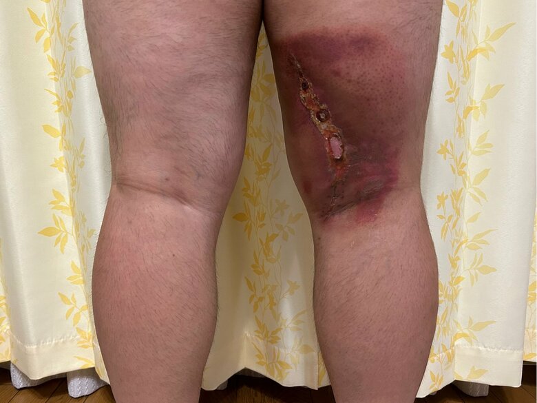 放射線治療の影響で皮膚がただれた状態に