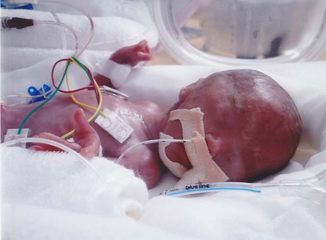 生後すぐの陽華ちゃん