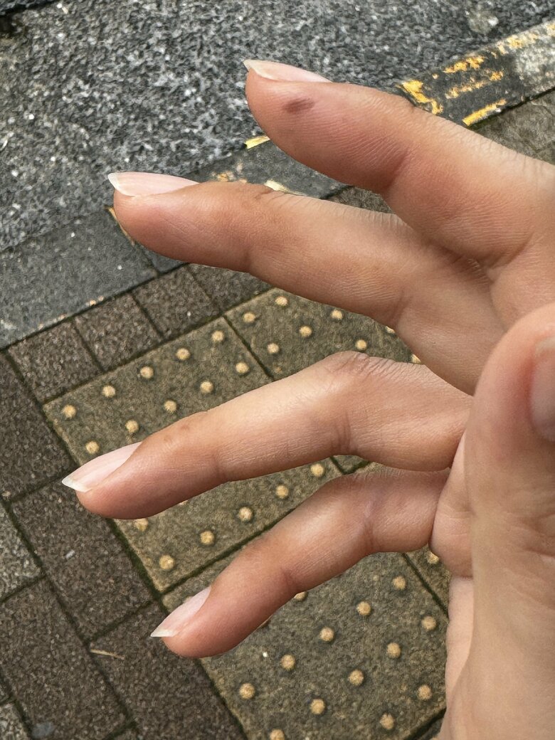 副作用の手足症候群による黒ずみ