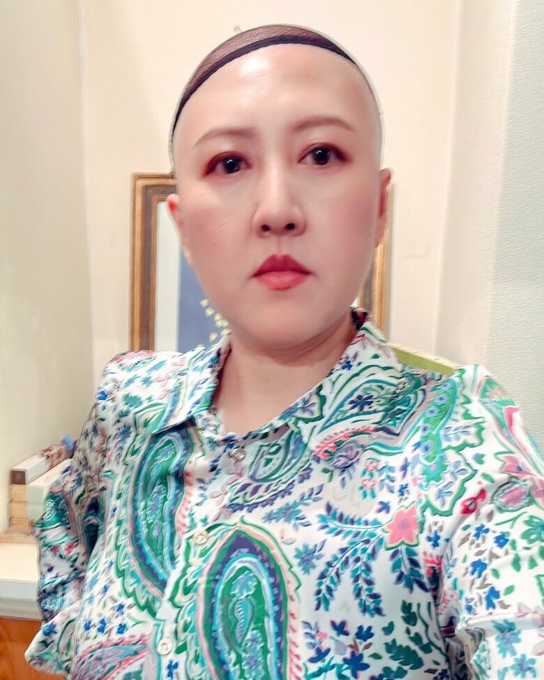 抗がん剤治療の副作用で脱毛を経験