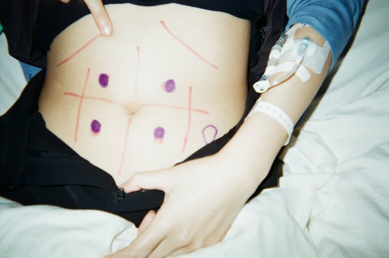 がんの手術前日