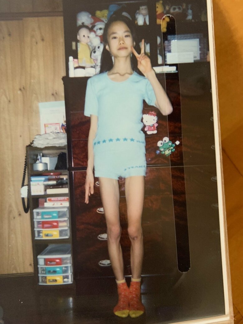 拒食症からなかなか抜け出せなかった中学2年生のころの入院直前の姿