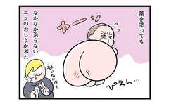 長女のお尻のかぶれ「なかなか治らない!!」【漫画】