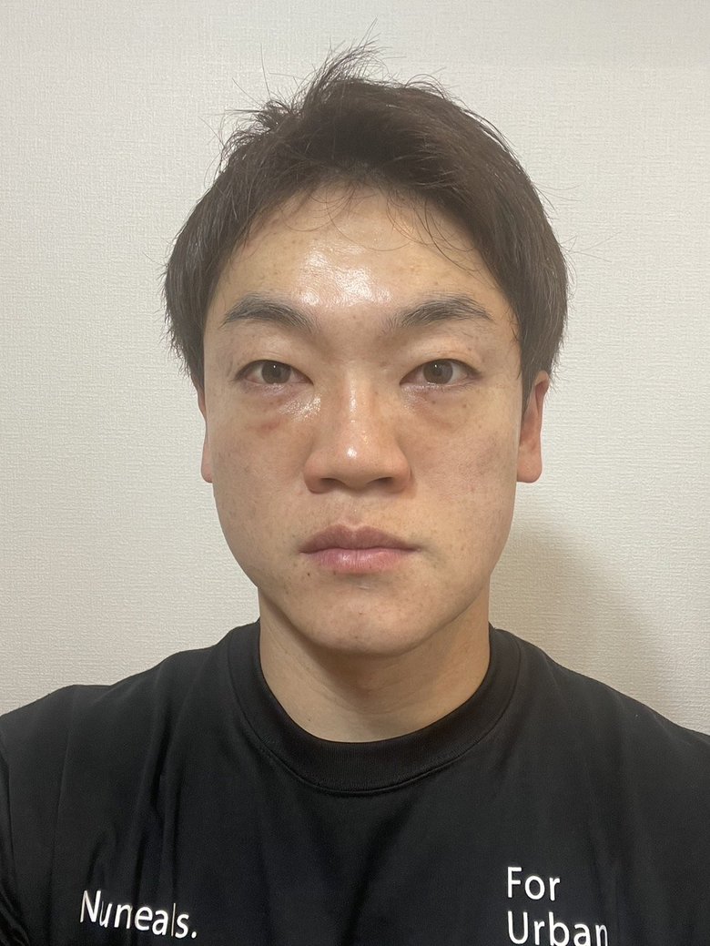 術後のパンパンの顔でテレビ収録へ