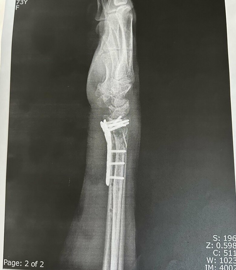 ケガした腕を横から見た図。プレートで腕を固定した
