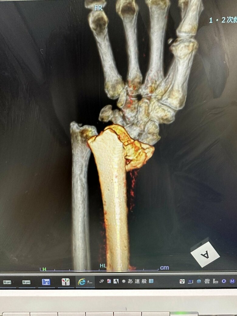 転倒し腕を大ケガ。骨がズレているのがわかる