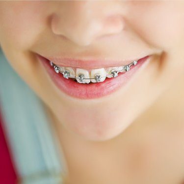 子どもの「歯並び」歯列矯正したほうがいいケースと治療の進め方